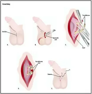 Finding the Best Vasectomy Clinics in NZ: What to Look For